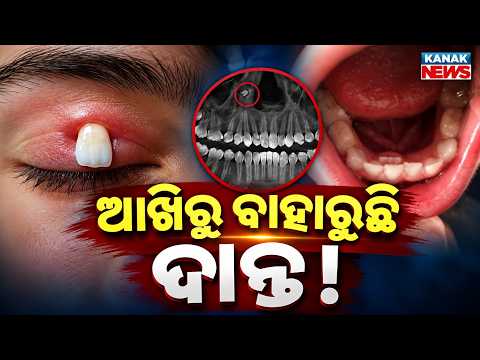ଆଖିରୁ ବାହାରୁଛି ଦାନ୍ତ ! Special Report On Tooth Growing Above Eye in 16-Year-Old Boy | Stuns Doctors