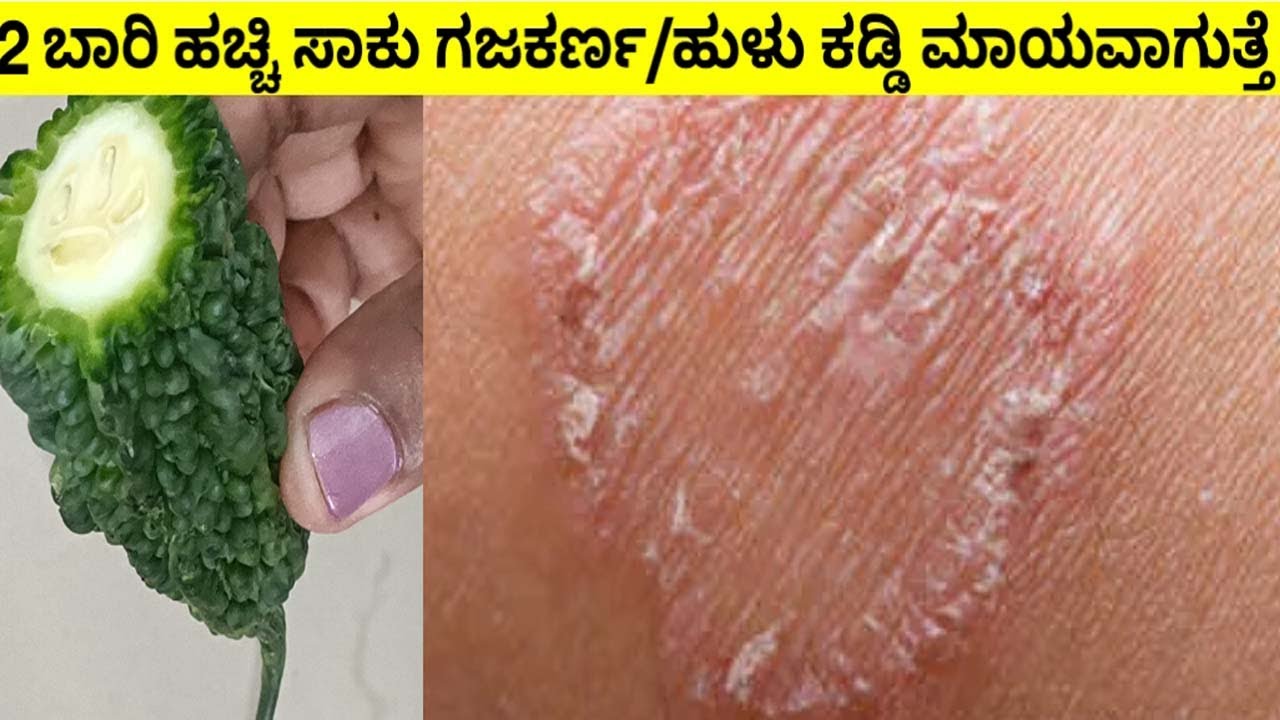 ಹುಳುಕಡ್ಡಿ/ ಗಜಕರ್ಣ ತುರಿಕೆ ಕಜ್ಜಿ 2 ದಿನದಲ್ಲಿ ಮಾಯವಾಗುತ್ತೆ/ Fungal Infection Treatment T Home