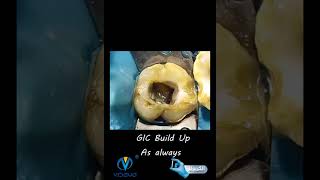 Clincal Cases in endodontics with El-Carpula - case 4