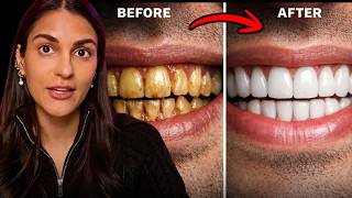 How To Whiten Your Teeth Without Damaging Them