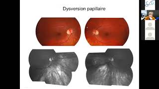 Interview Opthalmologie webinar SFO Champs visuel - Mars 2021