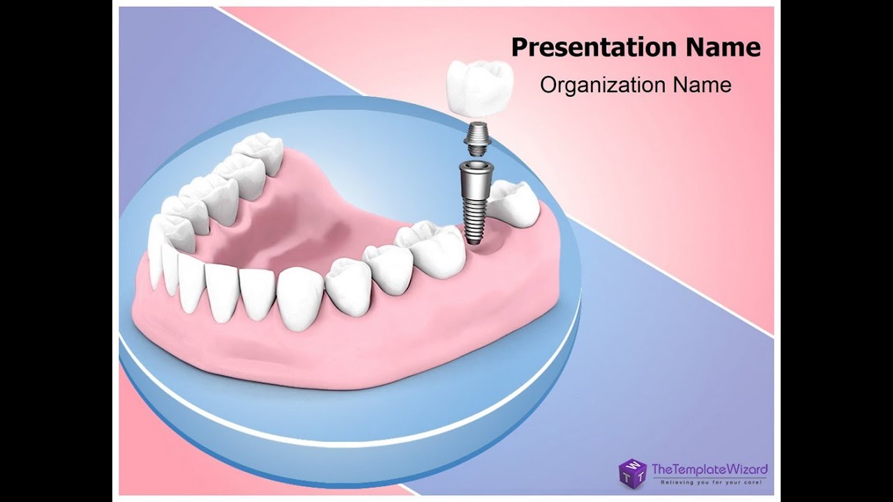 Dental Implant PowerPoint Presentation Template TheTemplateWizard 