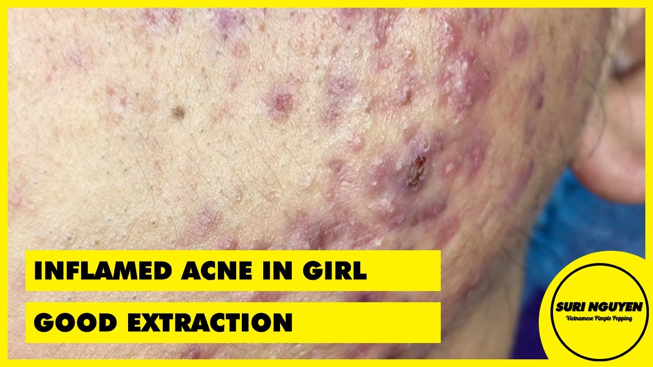 Suri Job 51: GOOD EXTRACTION INFLAMED ACNE IN A YOUNG GIRL