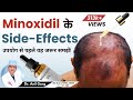 Minoxidil Side Effects -  मिनोक्सिडिल के साइड इफेक्ट्स क्या है ? How To Get Best Minoxidil Results
