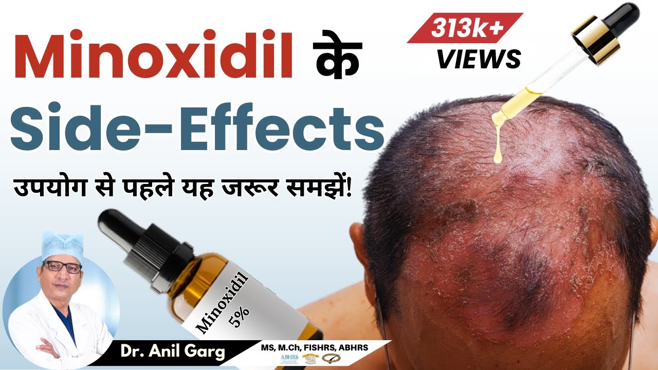 Side Effects of Minoxidil मिनोक्सिडिल के साइड इफेक्ट्स क्या है ? How