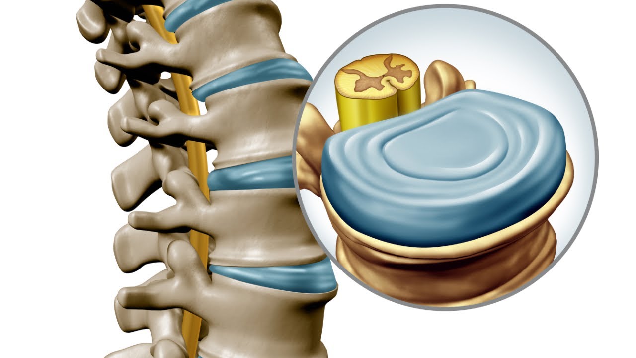 How to Overcome Spinal Arthritis | Mechanicsville VA Chiropractor | Dr. Tripp Stover