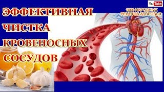 КАК ЭФФЕКТИВНО ОЧИСТИТЬ КРОВЕНОСНЫЕ СОСУДЫ ОТ ХОЛЕСТЕРИНОВЫХ БЛЯШЕК.ИЗБАВЛЯЕМСЯ ОТ АТЕРОСКЛЕРОЗА КАК ЭФФЕКТИВНО ОЧИСТИТЬ КРОВЕНОСНЫЕ СОСУДЫ ОТ ХОЛЕСТЕРИНОВЫХ БЛЯШЕК.ИЗБАВЛЯЕМСЯ ОТ АТЕРОСКЛЕРОЗА