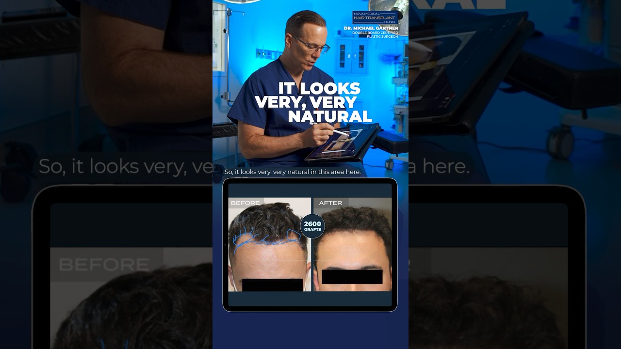 🔥Dr. Gartner Unveils a Remarkable Hair Transplant Case / 