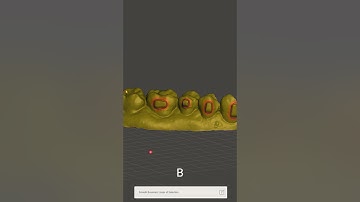 Meshmixer: fastest way how to remove orthodontic brackets.