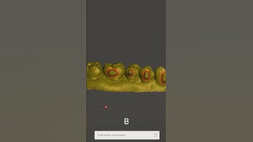 Meshmixer: fastest way how to remove orthodontic brackets.