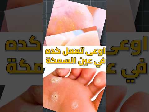 قشر الموز و روح الخل لعلاج عين السمكة دكتور ايمن   عين السمكه