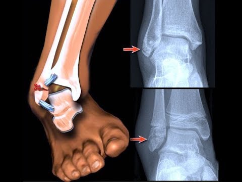 Vídeo: Como Trabalhar Uma Perna Com Fratura No Tornozelo
