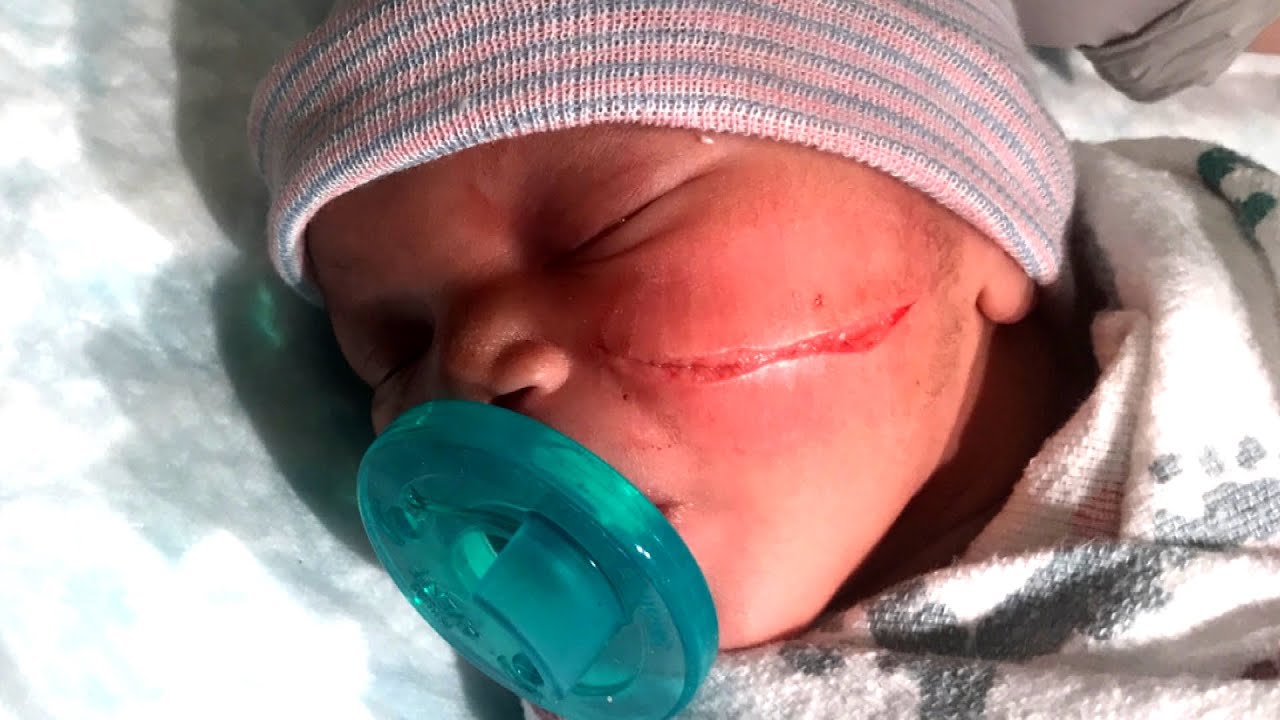 ⁣Newborn Gets Gash on Face From C-Section Scalpel