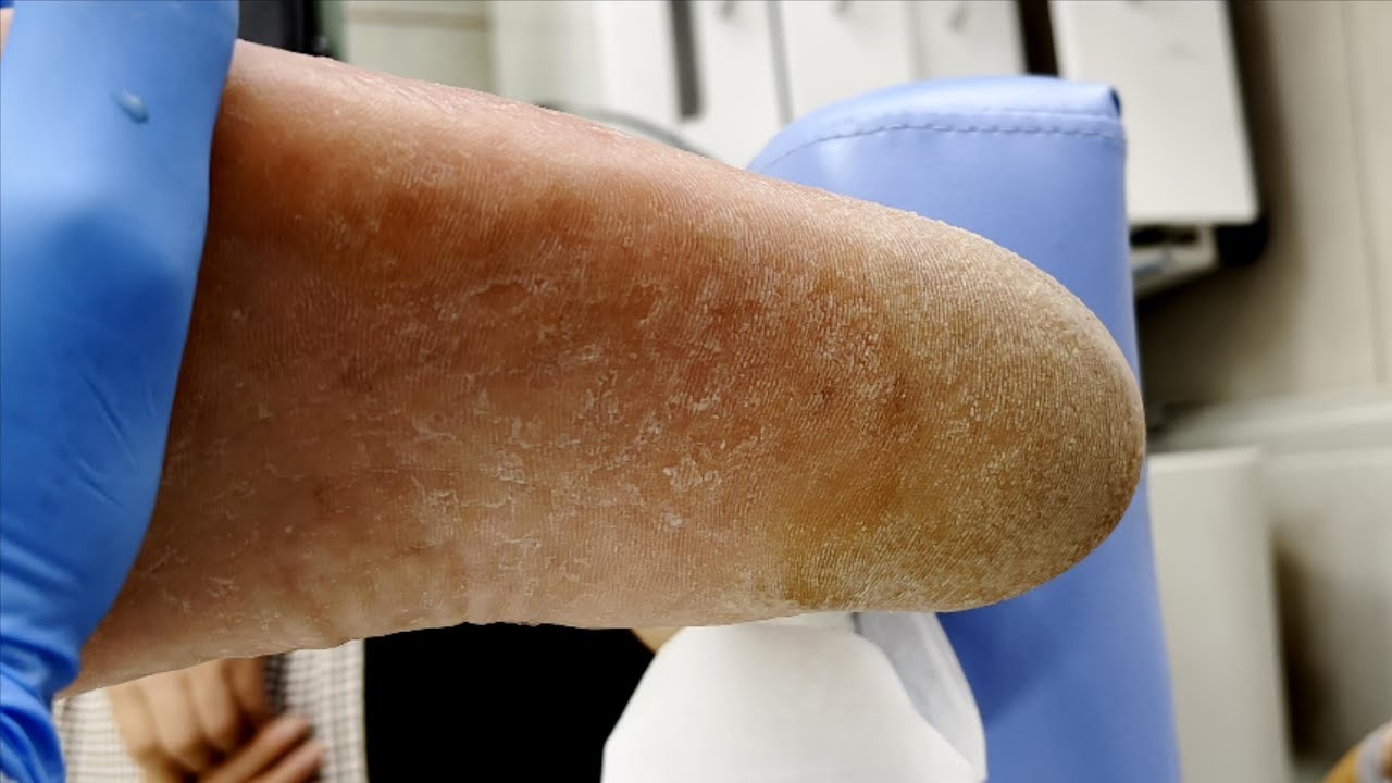 The process of completely removing the foot pads is very enjoyable【Xue