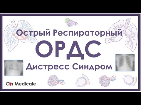 Острый респираторный дистресс синдром - ОРДС - механизм развития, причины, патофизиология