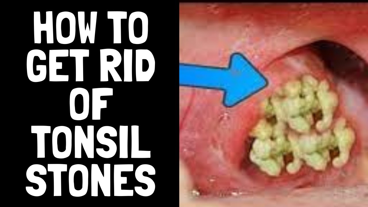 Tonsil Stones How To Remove Them Youtube