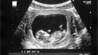 UC Davis performs 'miracle' surgery on unborn baby STILL IN THE WOMB HD video Image of UC Davis performs 'miracle' surgery on unborn baby STILL IN THE WOMB HD video
