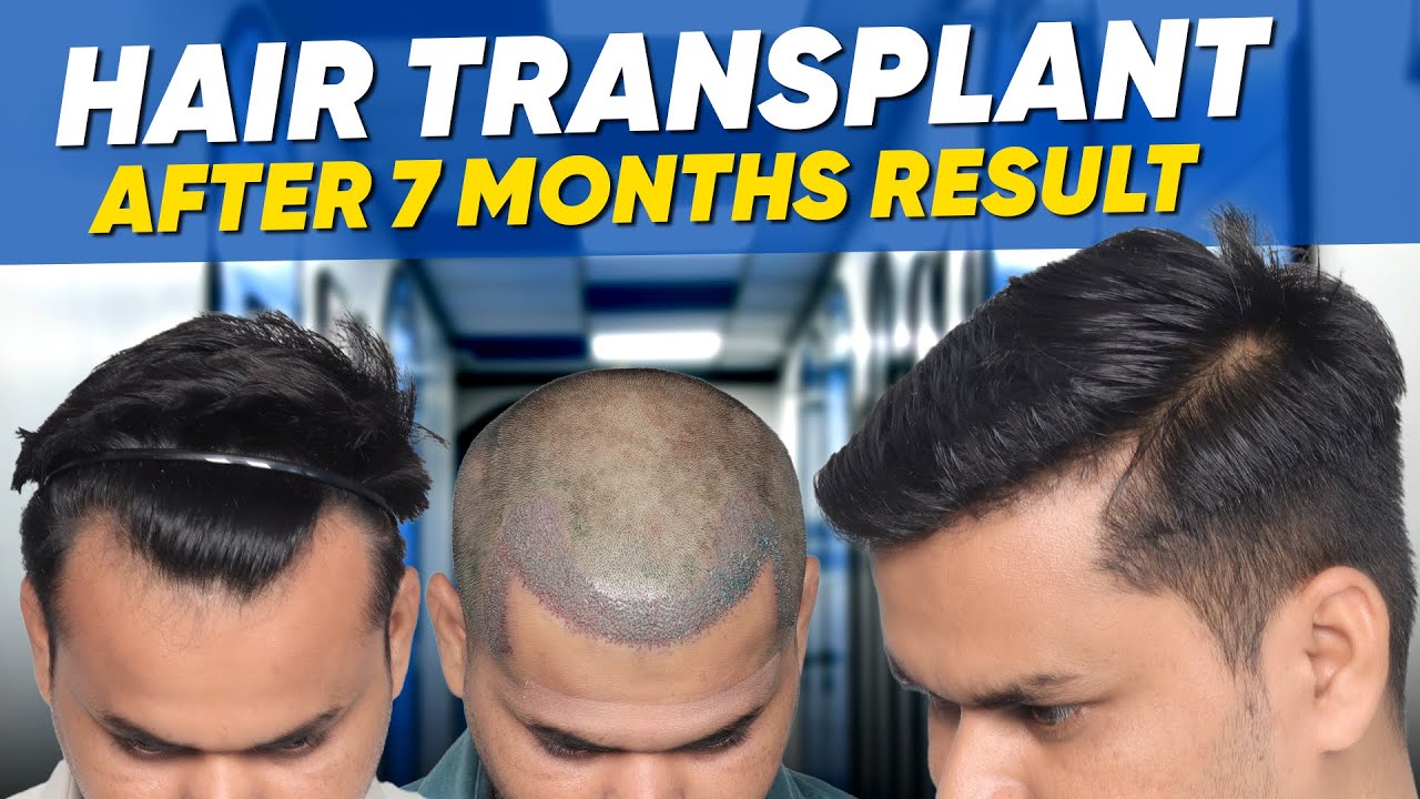 Hair Transplant in Madurai Best Results & Cost of Hair Transplant in