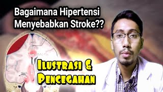 Bagaimana Darah Tinggi (Hipertensi) Menyebabkan Stroke, Ilustrasi, Penjelasan, dan Pencegahan