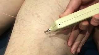 Electro acupuncture therapy for the hamstrings