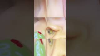 ASMR Ear Cleaning – Removing a Wax Blockage That Could Harm Your Hearing