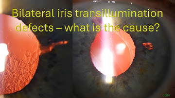 0004: Bilateral iris transillumination defects - what is the cause?