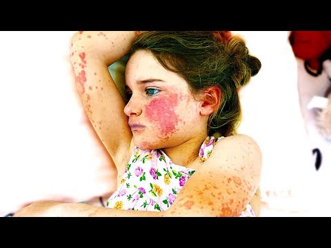 we-found-her-with-maculopapular-rash-(shocking)