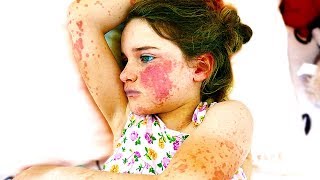 WE FOUND HER WITH MACULOPAPULAR RASH (SHOCKING)