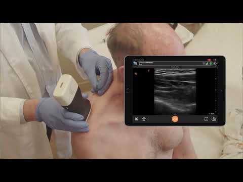 Suprascapular Nerve Block
