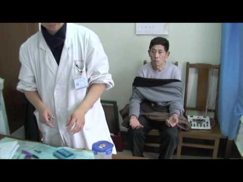 Acupuncture Treatment in Shanghai China - YouTube