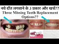 नये दाँत लगवाने के 3 प्रकार और खर्च?? Three Missing Teeth Replacement Options?? Replacement Of Teeth