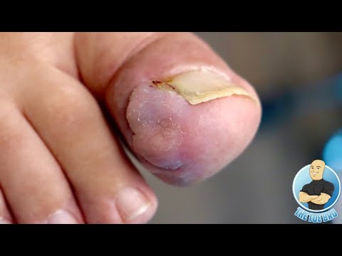 SEVERE INGROWN TOENAIL LEFT FOR YEARS UNTREATED ***WARNING: DIFFICULT TO WATCH!!!***