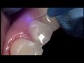 Laser Bacterial Reduction (LBR) with a Diode Laser