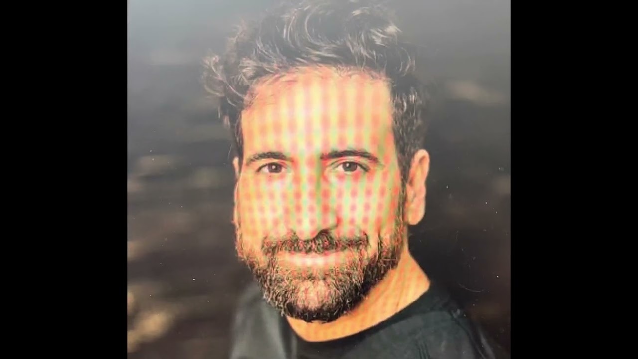 Dr. Lombardi explains Motor Point Acupuncture