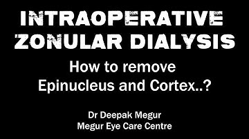 Intraoperative Zonular Dialysis. How to remove Epinucleus and Cortex..? - Dr Deepak Megur