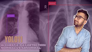 YOLO11: AI Chest X-Ray Detection (Normal vs Abnormal)