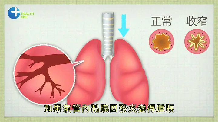 為什麼哮喘找上我？ - 天天要聞