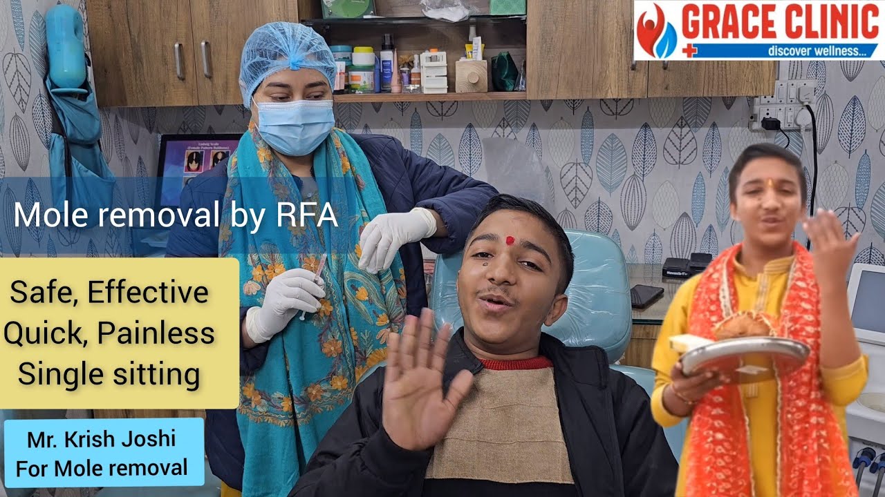 Mole removal by RFA Grace clinic Dehradun | Krish Joshi Mole removal by Dr. naziya khatun