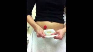 Ostomy pouch change using ConvaTec moldable
