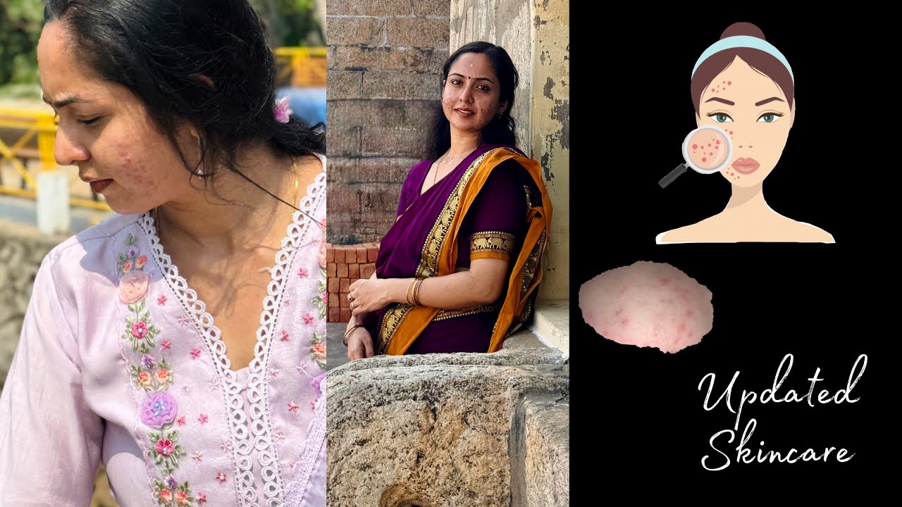 My Acne Care Products | Current Skincare | Updated Skincare | Malayalam 