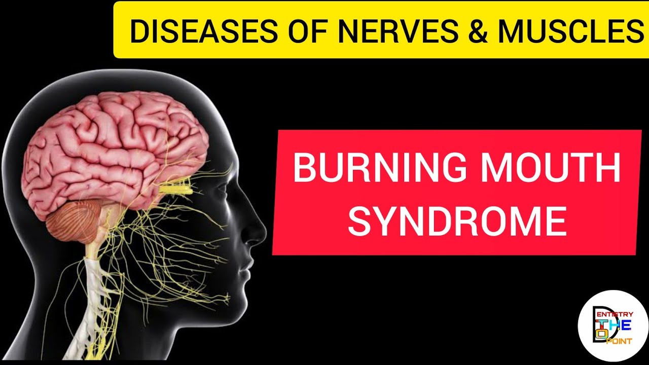 BURNING MOUTH SYNDROME YouTube