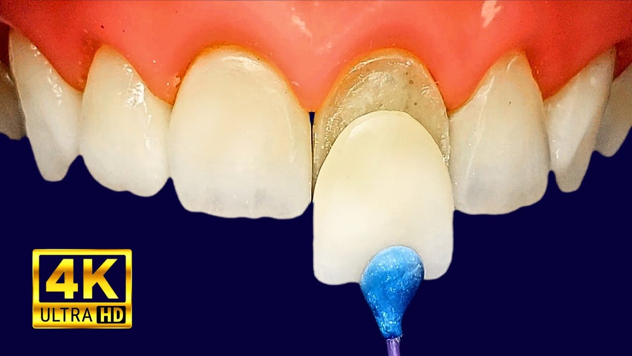 Incredible Front Tooth Veneer procedure | Satisfying Video