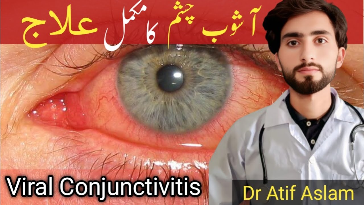 "Red Eye Disease? Adenoviral Conjunctivitis Symptoms, Treatment & Prevention" | Dr Atif Aslam
