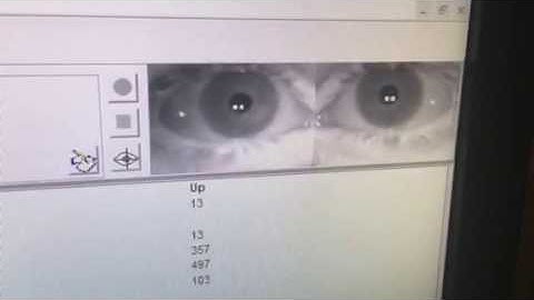 Minnesota Concussion Help- VNG vertical saccades