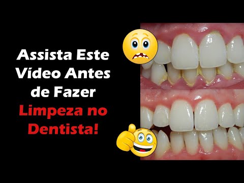 Vídeo: Como os dentistas cuidam dos dentes