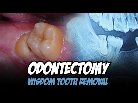 ODONTECTOMY | PENCABUTAN GERAHAM BUNGSU | Dentist | Dokter Gigi Tri Putra