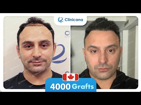 Sammy’s hair transplant