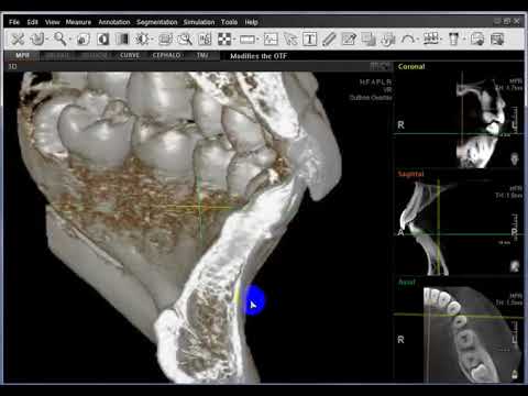 Ez3d2009. Программы для планирования имплантации. Ez3d Plus плотность кости. Кт при планирование импланта.