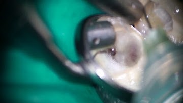 Broken file removal with HyFlex EDM