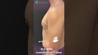 İleri Derece Jinekomasti Şoku! 😲 (İnanılmaz Öncesi &amp; Sonrası)